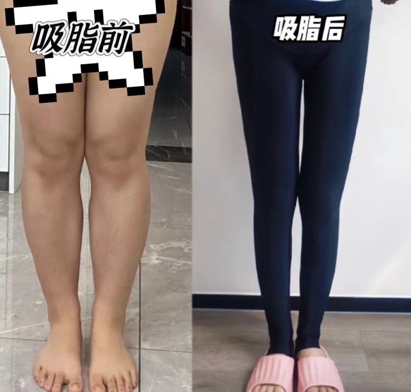 吸脂减肥